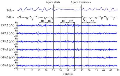 Sleep Electroencephalographic Response to Respiratory Events in Patients With Moderate Sleep Apnea–Hypopnea Syndrome